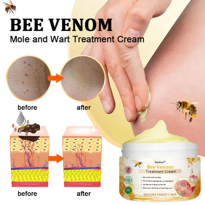 🐝[🐝𝐎𝐟𝐟𝐢𝐜𝐢𝐚𝐥 𝐁𝐫𝐚𝐧𝐝 𝐒𝐭𝐨𝐫𝐞🐝] 𝐀𝐰𝐳𝐥𝐨𝐯𝐞™ 𝐁𝐞𝐞 𝐕𝐞𝐧𝐨𝐦 𝐌𝐨𝐥𝐞 𝐚𝐧𝐝 𝐖𝐚𝐫𝐭 𝐓𝐫𝐞𝐚𝐭𝐦𝐞𝐧𝐭 𝐂𝐫𝐞𝐚𝐦 (👨‍⚕𝐄𝐌𝐀 𝐑𝐄𝐂𝐎𝐌𝐌𝐄𝐍𝐃𝐒)